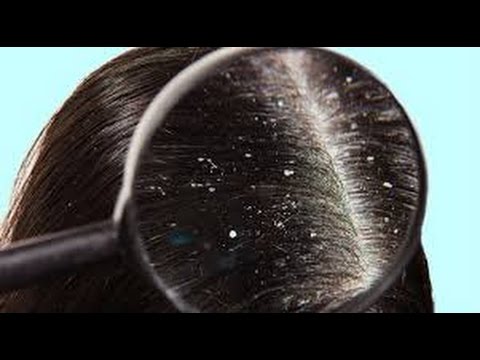 Descubre el secreto para un cabello libre de caspa con el champú anticaspa Hanan Beauty