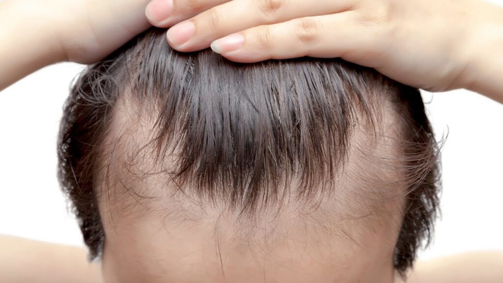 Descubre el champú para tratar la alopecia frontal fibrosante en solo 3 semanas